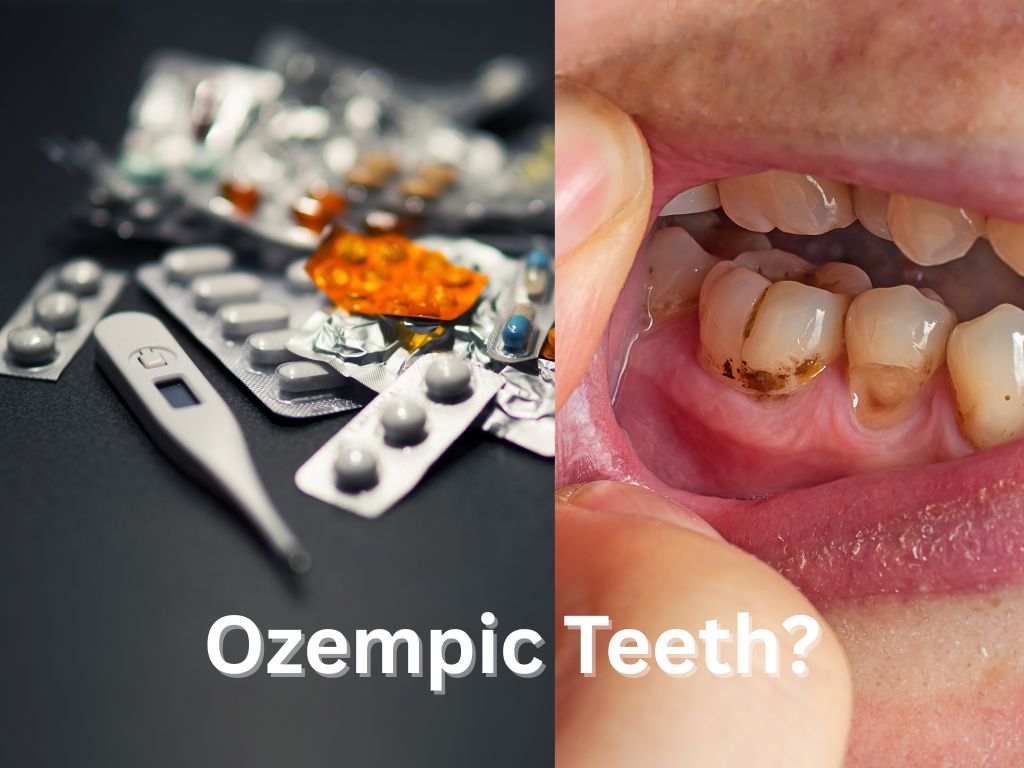Ozempic Teeth: From Waist Line To Gum Line