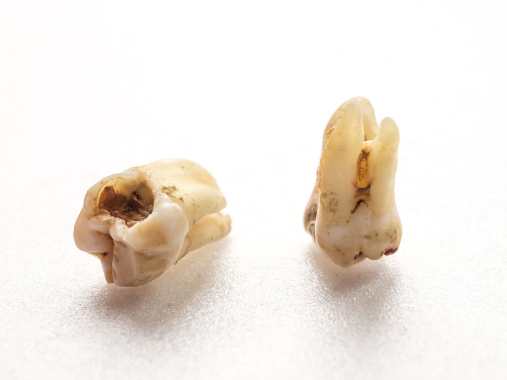 Weight Loss Drugs Can Lead to Enamel Erosion