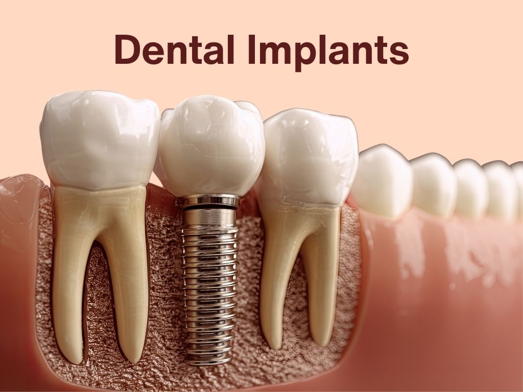 Dental Implants: The Permanent Solution for Missing Teeth?