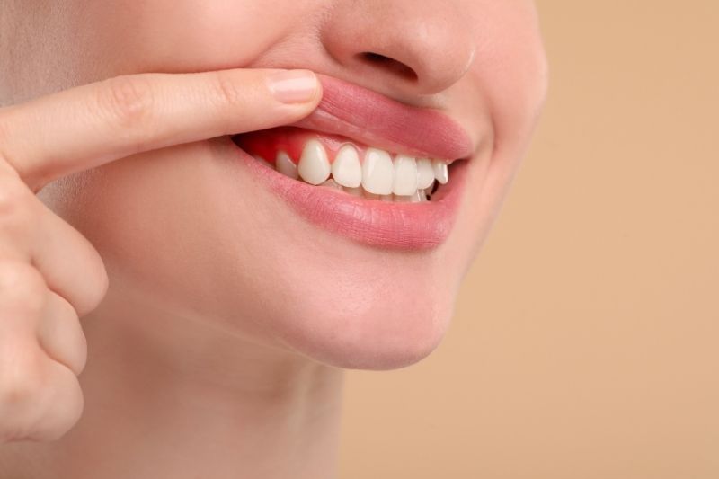 Gum irritation - may not be an issue with the new teeth whitening powder