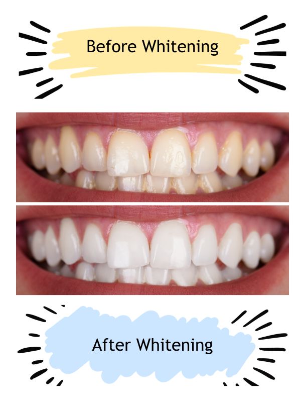Yellow and White Teeth