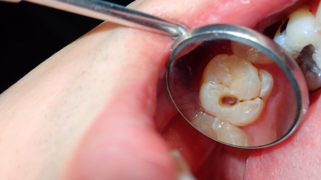 Curodont can help with cavities
